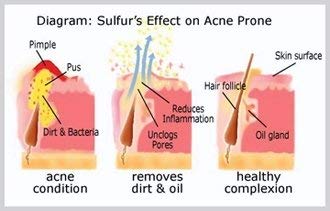Joesoef Anti-Acne Soap, Natural Volcanic Sulfur