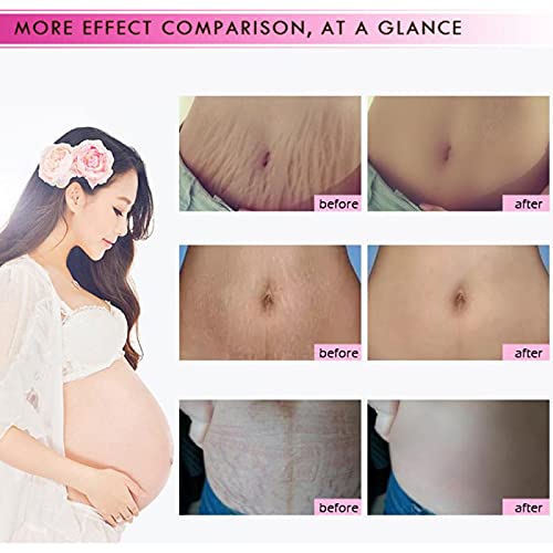 Mango Stretch Marks and Scar Cream,