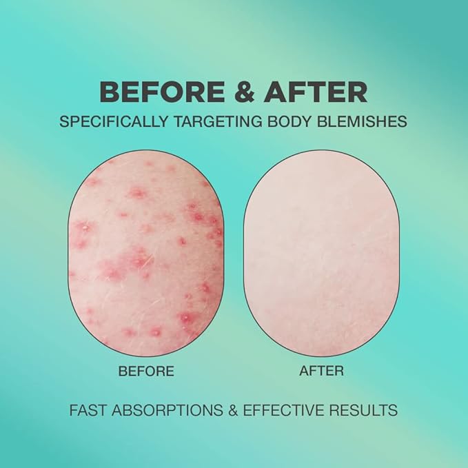 Butt Acne Cream | Butt Acne