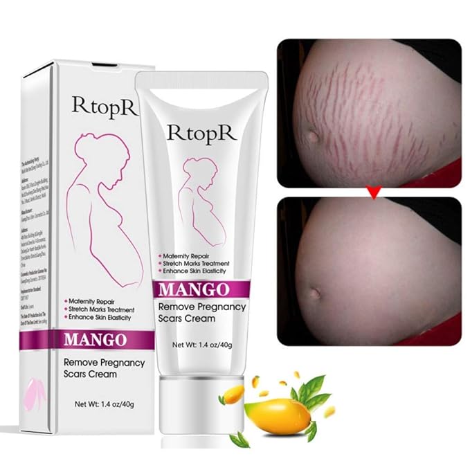 Mango Stretch Marks and Scar Cream,
