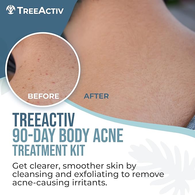 TreeActiv 90-Day Body Acne Treatment Kit, Exfoliating