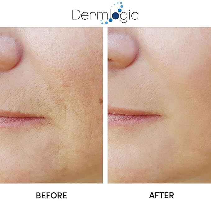 Anti Aging Resurfacing Peel Pads - Contains Salicylic, Glycolic, & Lactic for Face & Body. Includes Hyaluronic, & Witch Hazel, Green Tea & Aloe Vera. Exfoliates to Correct Dark Spots & Scars.