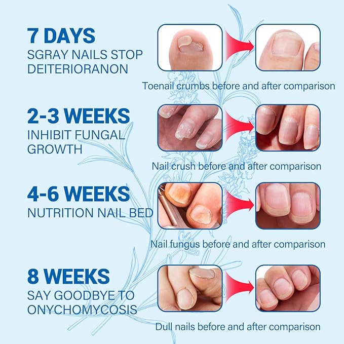 Toenail Fungus Treatment, Toe Nail