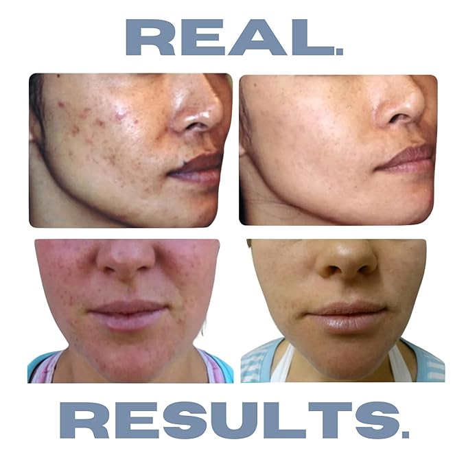 Acne Treatment Kit, Acne Kit, Skin