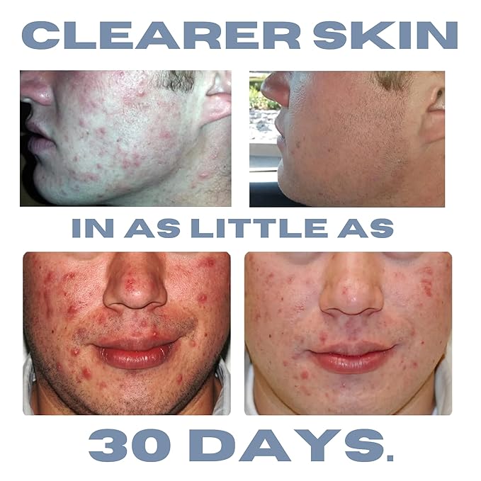 Acne Treatment Kit, Acne Kit, Skin