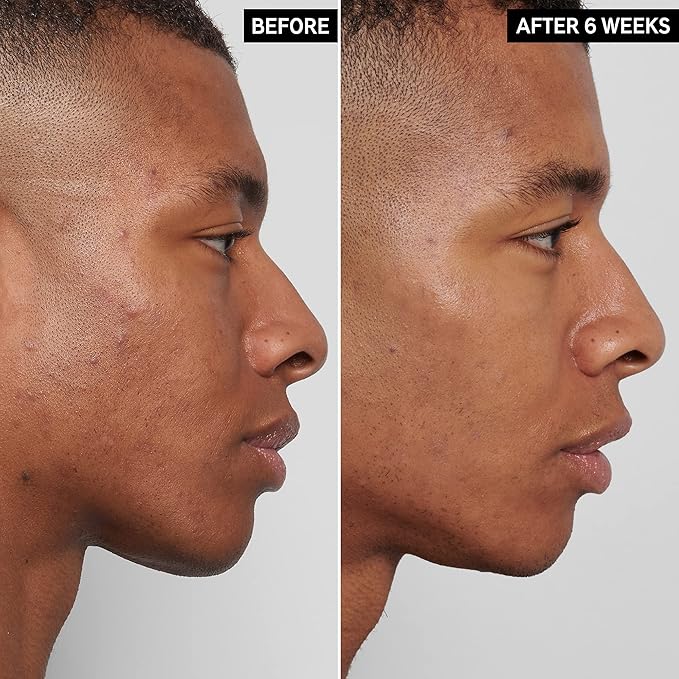 The INKEY List Mandelic Acid Treatment, .5 fl oz