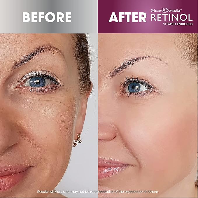 Retinol 6X Super Retinol Serum – Unique, Intensive Formula Accelerates Skin Renewal While You Sleep – Targets Fine Lines, Wrinkles, Dark Spots, Pores & Blemishes to Restore Beautiful, Glowing Skin
