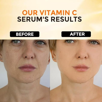 Vitamin C Face Serum With Hyaluronic Acid - Anti Aging Serum - Reduce Dark Spots, Professional Grade Treatment For Face & Eyes, Dark Spots,Acne,Wrinkles,For Men & Women