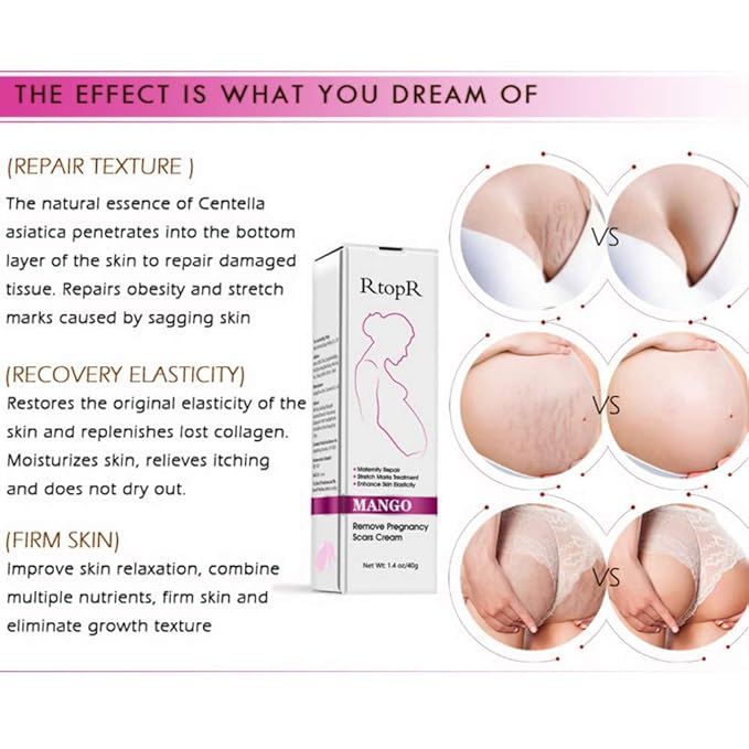Mango Stretch Marks and Scar Cream,