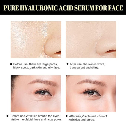 Protein Thread Lifting Set, Soluble Protein Thread and Nano Gold Essence Combination, Absorbable Collagen Thread for Face Lift, Reverse Collagen Serum for Face (With 1 x Protein Thread)