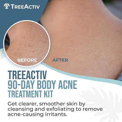 TreeActiv 90-Day Body Acne Treatment Kit, Exfoliating