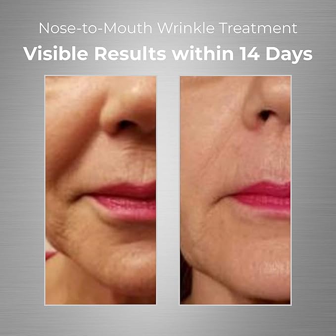 Nose-to-Mouth Wrinkle Treatment with UV Chromophores