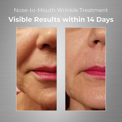 Nose-to-Mouth Wrinkle Treatment with UV Chromophores