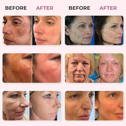 ABERA Skin Renewing Serum For Melasma Treatment, High-Potency Saffron Extract + Gift Curcumin Face Cleanser with Turmeric, Face Wash to Reduce Sebum (3 Boxes + Gift)