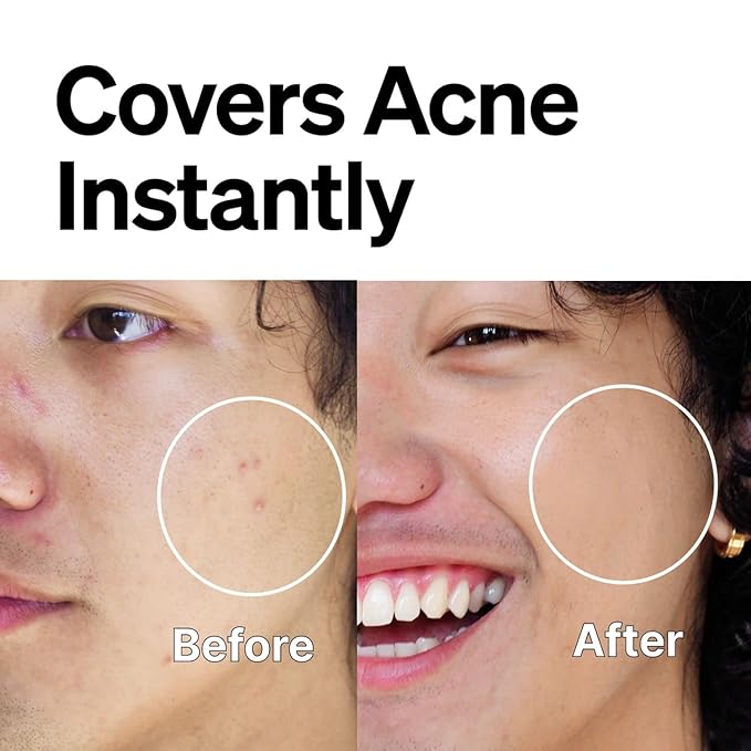 FRONTMAN Fade, Men's Acne Concealer With Salicylic Ac 2 L