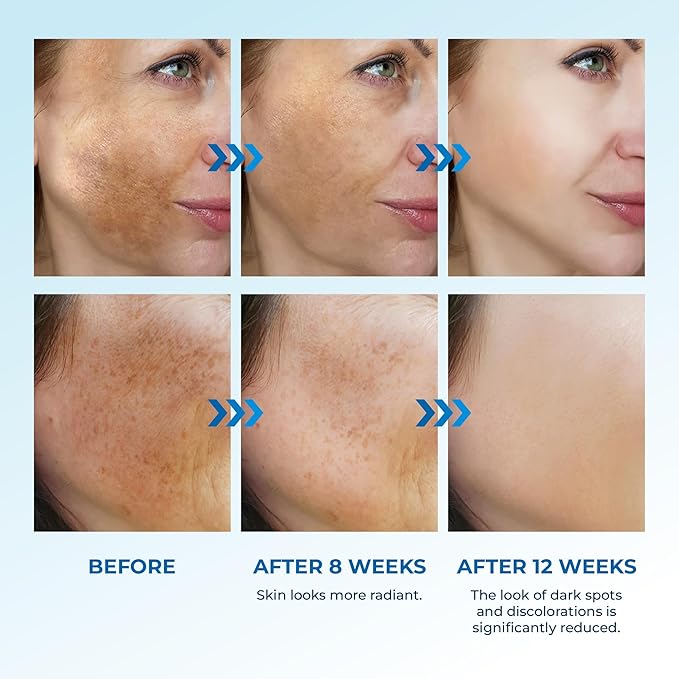 Abera Dark Spot Serum for Face, Dark Spot Corrector, Melasma & Age Spot Treatment, Boost Moisturization & Pore Minimize, All Skin Types, 0.68 fl Oz