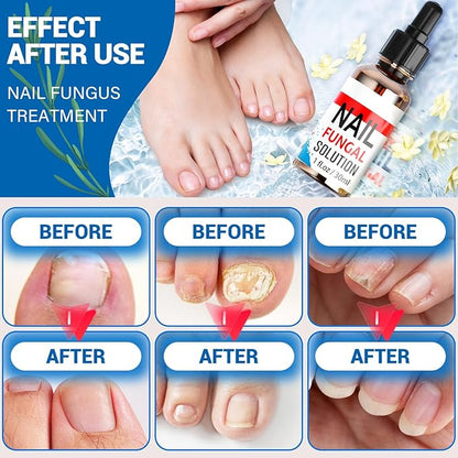 Toenail Fungus Treatment, Toe Nail