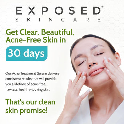 Exposed Skin Care Acne Treatment Serum