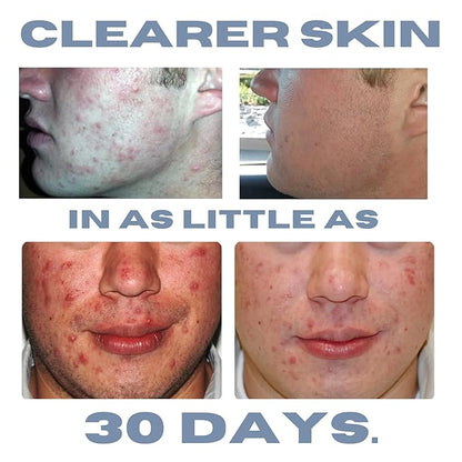 Acne Treatment Kit, Acne Kit, Skin