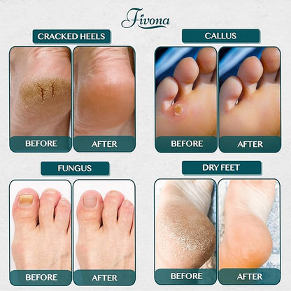 Foot Soak Epsom Salt with Tea Tree Oil 2 LB - Epsom Salt with Essential Oils for Healthy Toenails, Soothing Relief, Callus Softening - Pedicure Therapy for Soft, Rejuvenated Feet