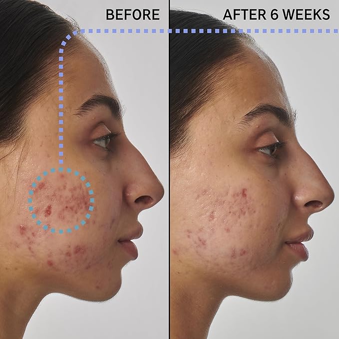 The INKEY List SuperSolutions 1% Retinol Serum for Face and Neck, Helps with Scar, Wrinkle and Skin Tone Appearance for Healthy-Looking Skin, 1.01 fl oz