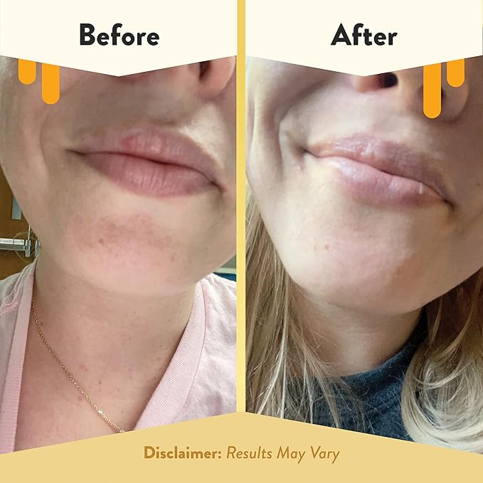 ECZEMA HONEY Nourishing Lip Balm -