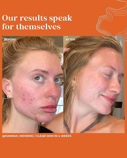 Clinical Clear + Control Healthy Skin Face Serum | All-Natural, Vegan, Cruelty-Free Spot Treatment for Clear Skin (1 FL OZ.)