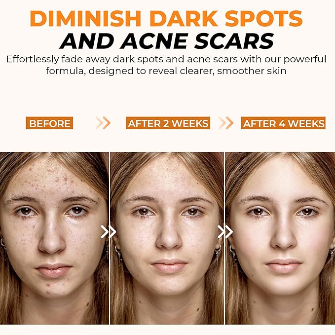 20% Vitamin C Serum 30ml - Maximum Strength Formula - Retinol, Hyaluronic Acid, Collagen - Treatment For Face & Eyes, Wrinkles